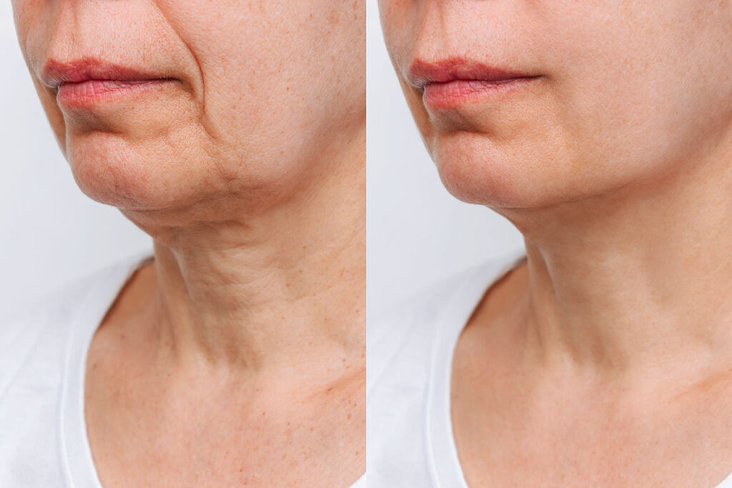 donna prima e dopo lifting viso e collo